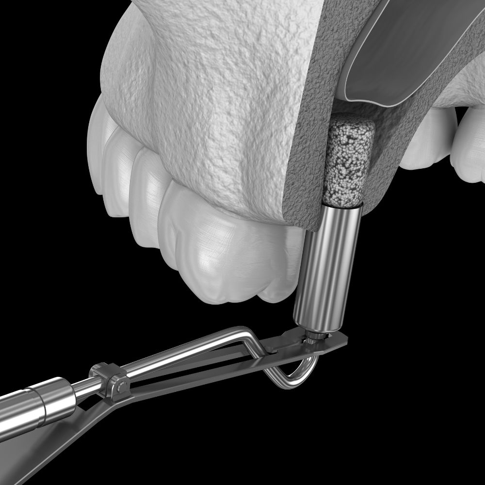 Chirurgie préimplantaire dentiste Sene